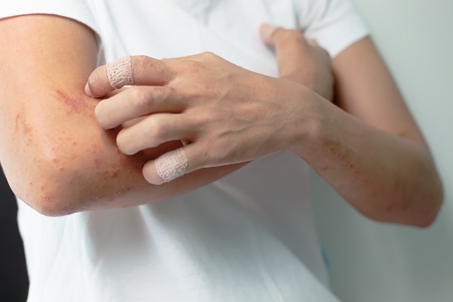 Adult Atopic Dermatitis - Eczema