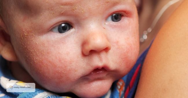 eczema infant
